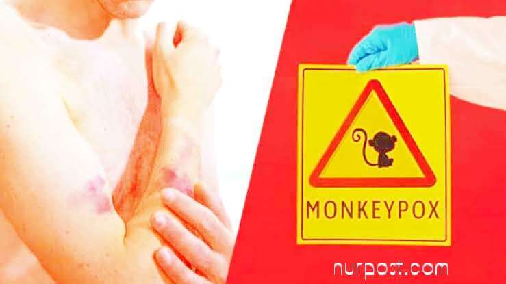 Monkeypox রোগ এর উৎপত্তি ও বিস্তার Monkeypox