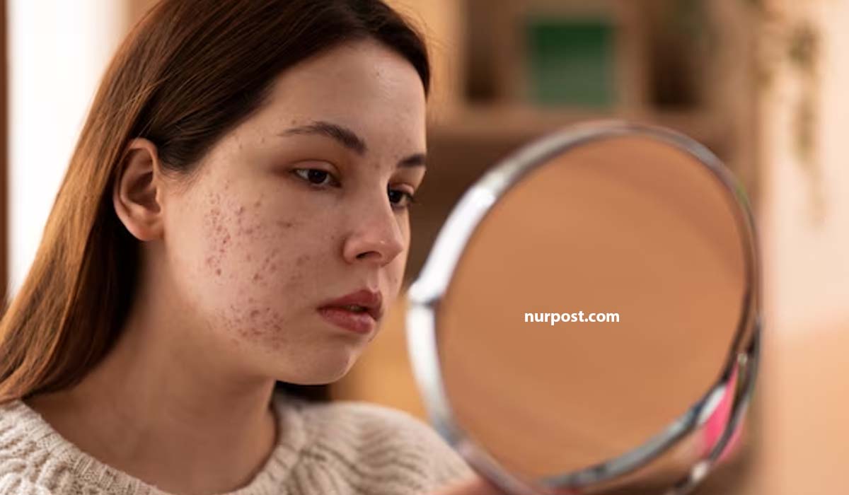 মেছতায় আক্রান্ত হলে চিকিৎসা পদ্ধতিগুলো কী কী মেছতায় আক্রান্ত হলে চিকিৎসা পদ্ধতিগুলো কী কী